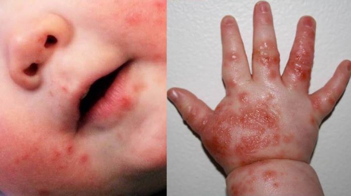 dấu hiệu bệnh tay chân miệng ở trẻ sơ sinh